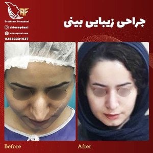 جراحی-بینی-10