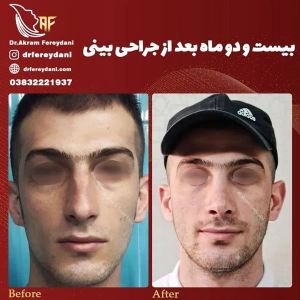 جراحی-بینی-100