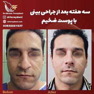 جراحی-بینی-101