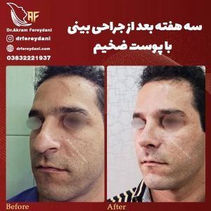 جراحی-بینی-102