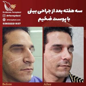 جراحی-بینی-103