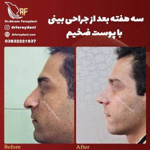 جراحی-بینی-104