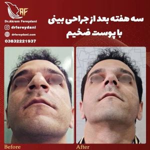 جراحی-بینی-105