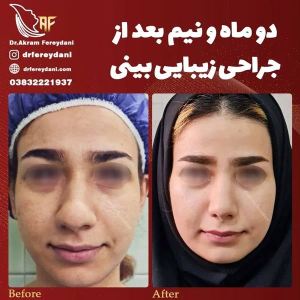جراحی-بینی-106