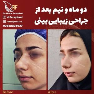 جراحی-بینی-107