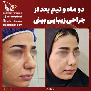 جراحی-بینی-108