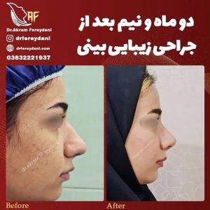 جراحی-بینی-109