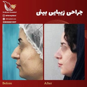 جراحی-بینی-11