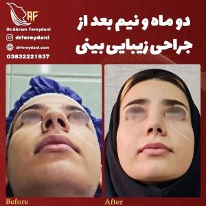 جراحی-بینی-110