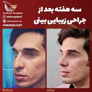 جراحی-بینی-111