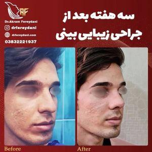جراحی-بینی-112