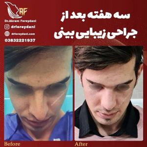 جراحی-بینی-113
