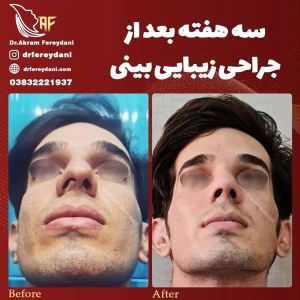 جراحی-بینی-114