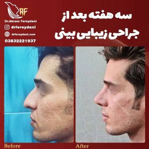 جراحی-بینی-115
