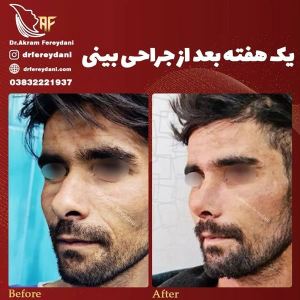 جراحی-بینی-118