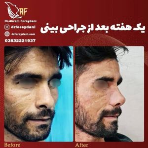جراحی-بینی-119