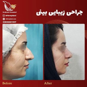 جراحی-بینی-12