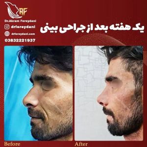 جراحی-بینی-120