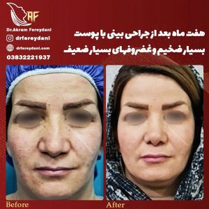 جراحی-بینی-121