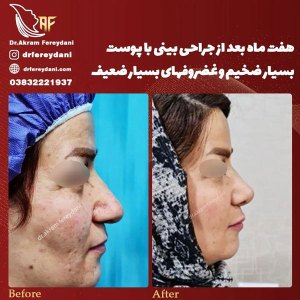 جراحی-بینی-122
