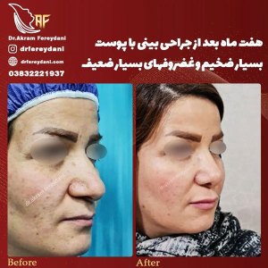 جراحی-بینی-123