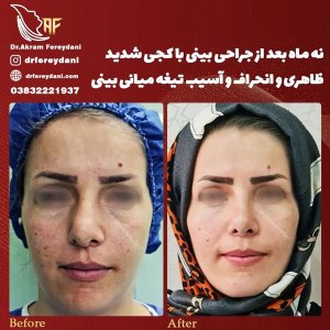 جراحی-بینی-124