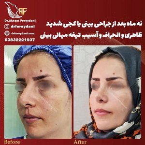 جراحی-بینی-125