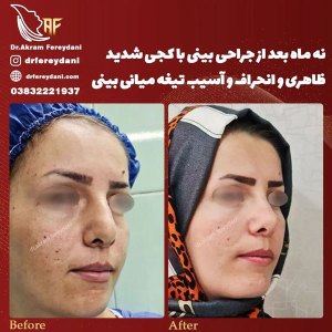 جراحی-بینی-126