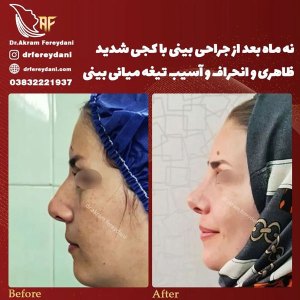 جراحی-بینی-127