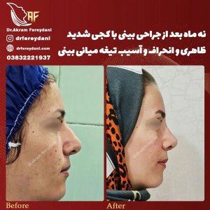 جراحی-بینی-128