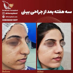 جراحی-بینی-129