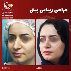 جراحی-بینی-13