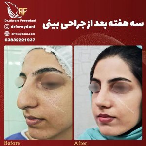 جراحی-بینی-130
