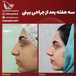جراحی-بینی-131