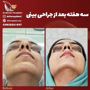 جراحی-بینی-132