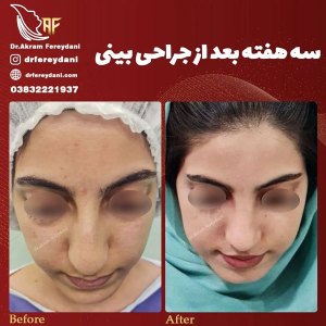 جراحی-بینی-133