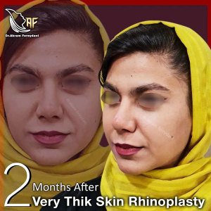 جراحی-بینی-134