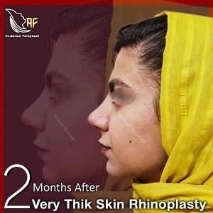 جراحی-بینی-135