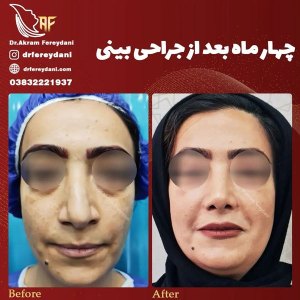 جراحی-بینی-136