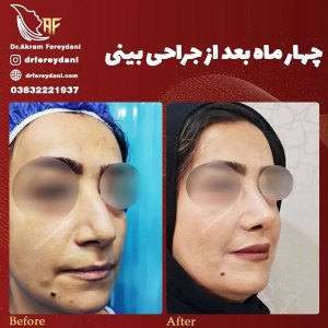 جراحی-بینی-137