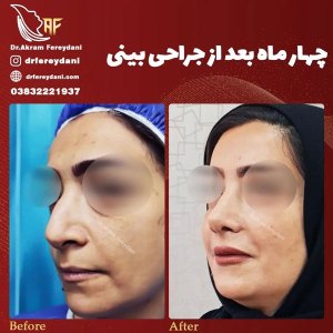 جراحی-بینی-138