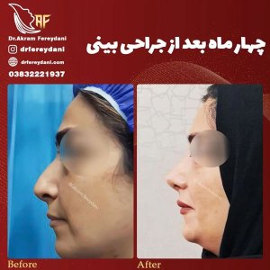 جراحی-بینی-139
