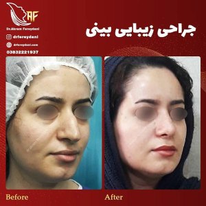 جراحی-بینی-14