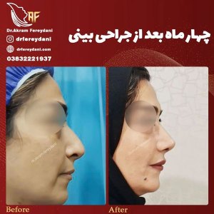 جراحی-بینی-140