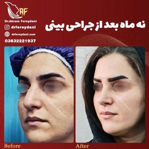 جراحی-بینی-141
