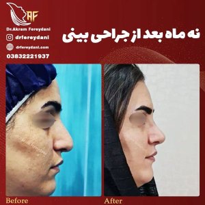 جراحی-بینی-142