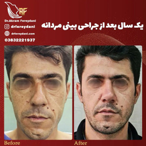 جراحی-بینی-144
