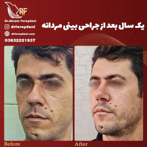 جراحی-بینی-145