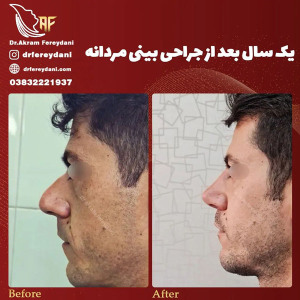 جراحی-بینی-146