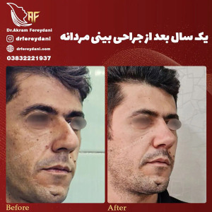 جراحی-بینی-147